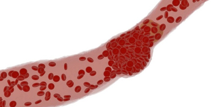 10 remédios caseiros para coágulo de sangue