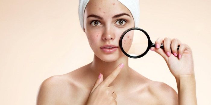 Como se livrar da acne (espinhas) rápido