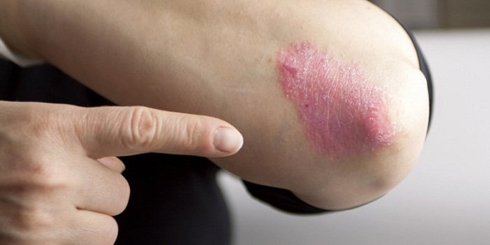 Eczema: sintomas, tratamento e causas