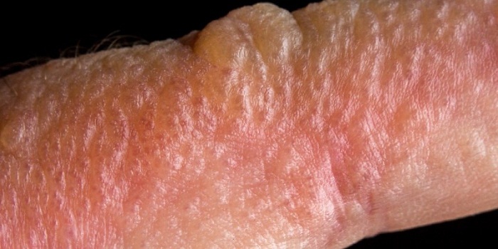 Erupção de Hera Venenosa: Causas, Tratamento e Prevenção