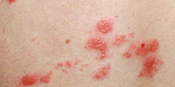 11 Tratamento Natural para Micose