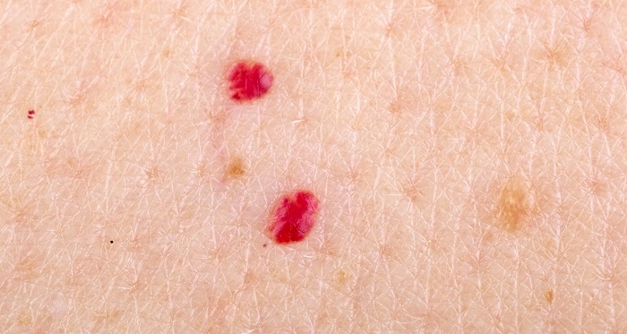 Fatores de risco de angioma de cereja, sintomas e tratamentos naturais