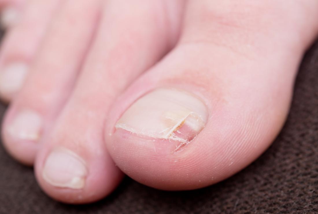 O que causa unhas quebradas ou rachadas?